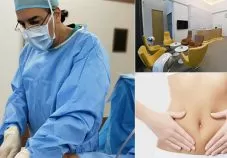 Dr Marco tummy tuck surgery