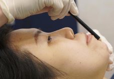 The-Clifford-Clinic chin augmentation