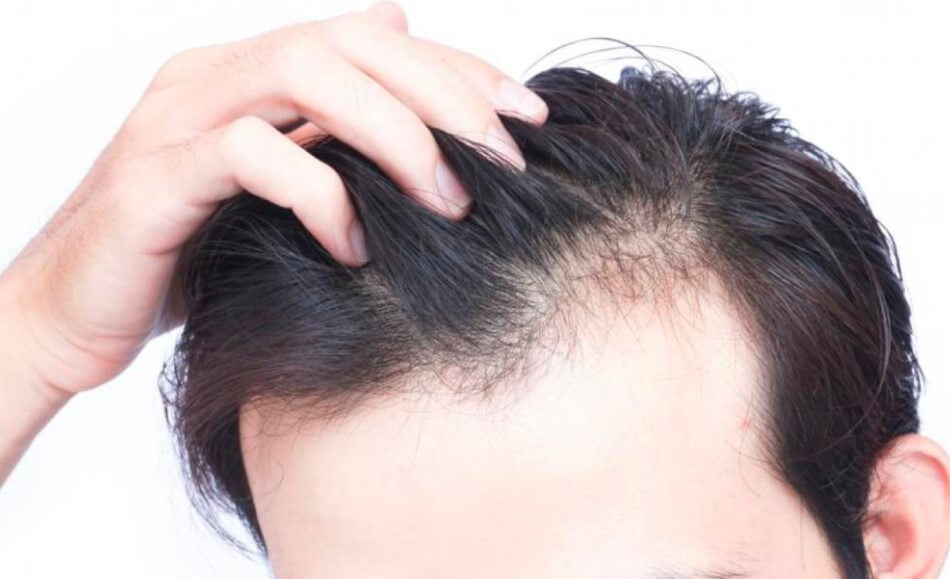 5 Best Hair Replacement & Hair Transplant Salons in Singapore