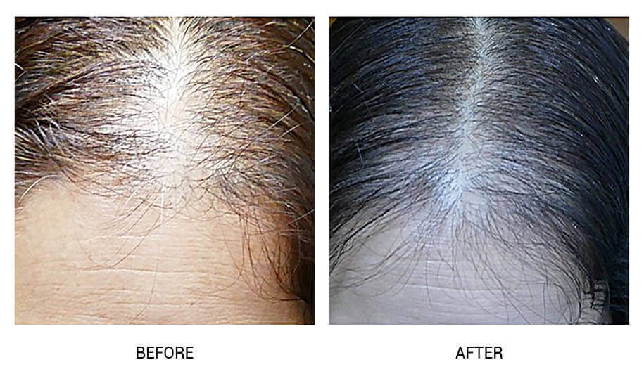 5 Best Hair Loss Treatment Services in Singapore [2023 Guide]
