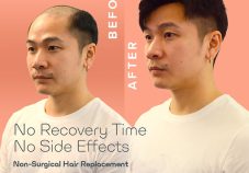 UEC Hair Replacement Singapore Review