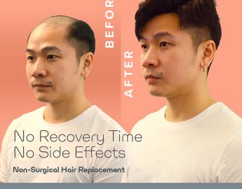 UEC Hair Replacement Singapore Review