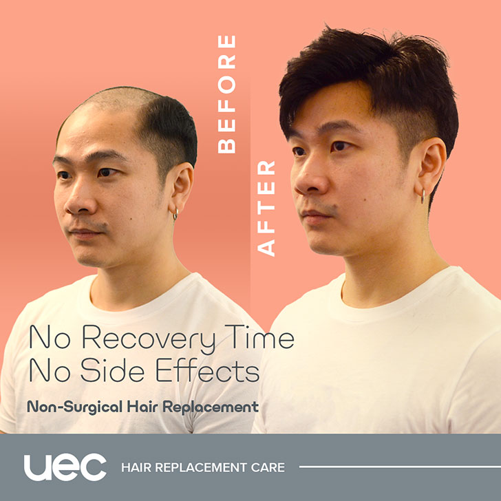5 Best Hair Replacement & Hair Transplant Salons in Singapore 5 Best Hair Replacement & Hair Transplant Salons in Singapore